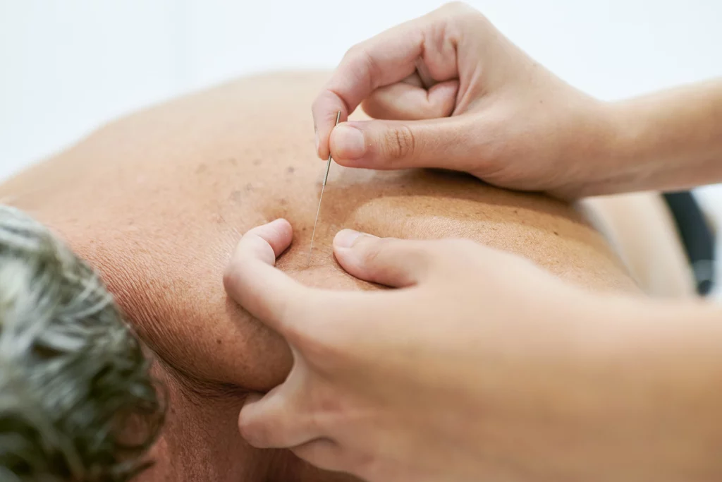 Close-up of practitioner putting acupuncture needles into a patient's shoulder