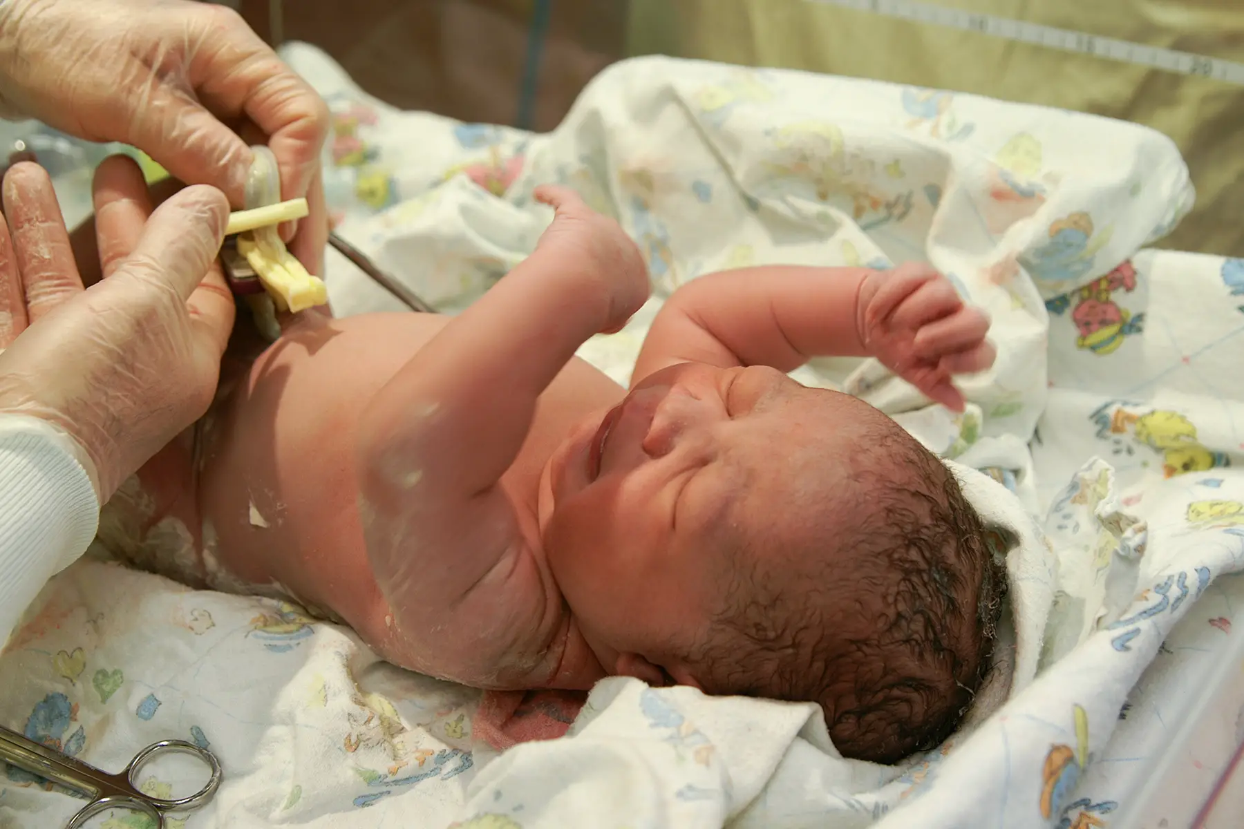 A doctor clamping the umbilical cord of a newborn baby