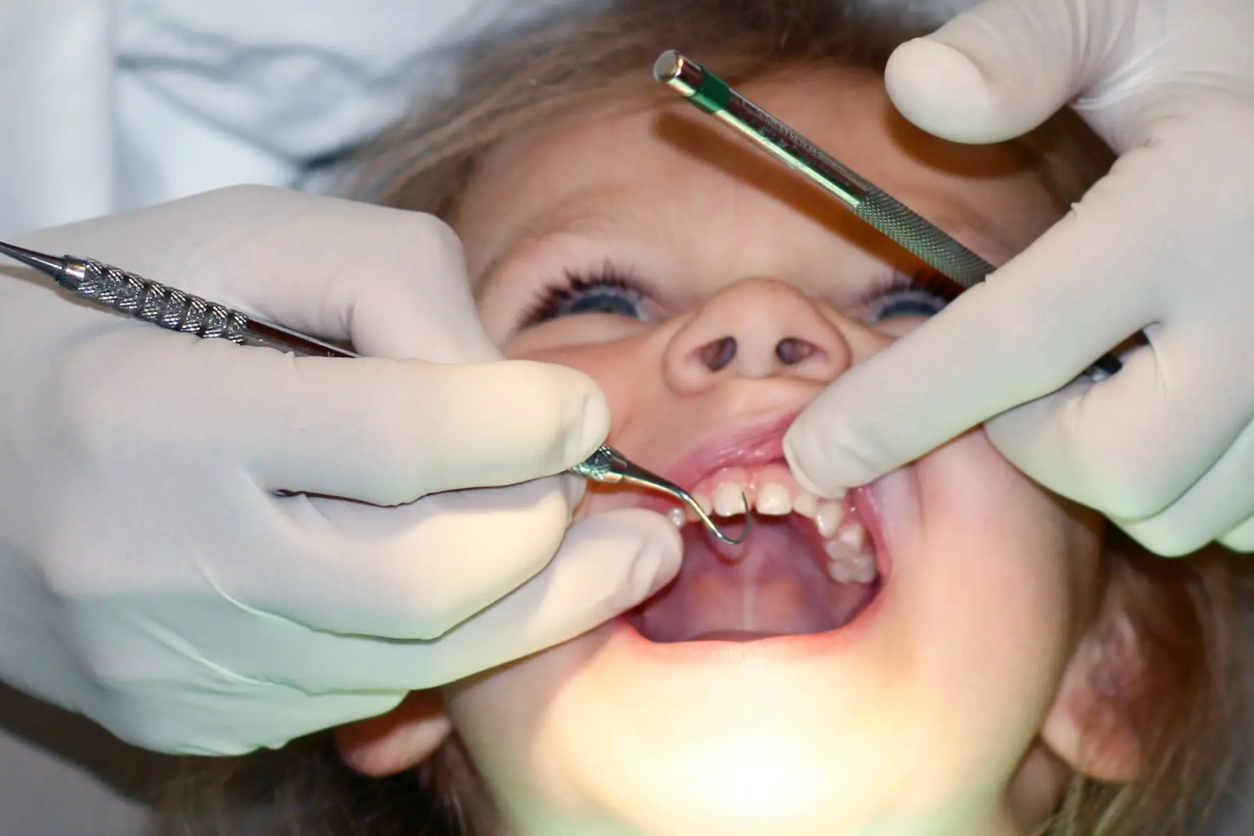 a young girl having a dental checkup with her mouth open wide so the dentist can check for cavities